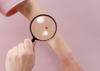 Dermatoscopii gratuite la Constanța, în campania „Soare Fără Pete”