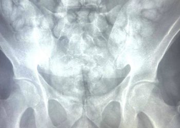 Prins pe Aeroportul Otopeni, cu aproape un kilogram de droguri în abdomen și în capsule lipite de corp (FOTO) 